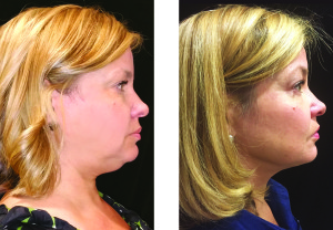 Before and After Kybella Double Chin Treatment