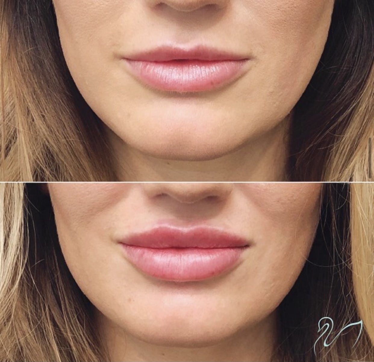 Lips using 1 syringe of Juvéderm Ultra. LOVE these results