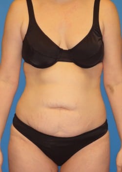 woman wearing black bra before tummy tuck