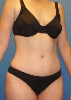 woman wearing black bra after tummy tuck with flatter stomach