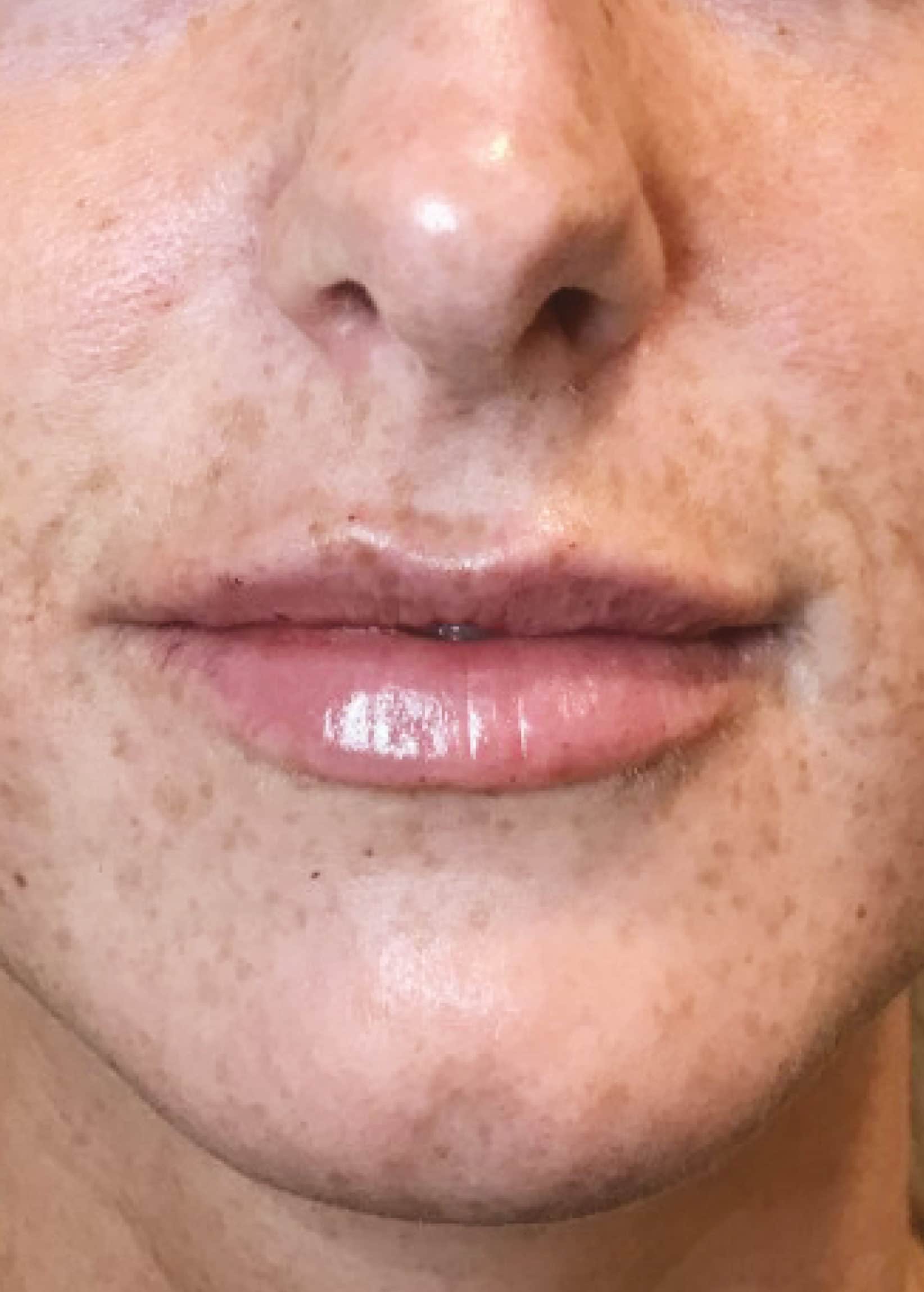 TheSkinCenter ProviderPages AliciaRyan LipFiller After 1 scaled 1