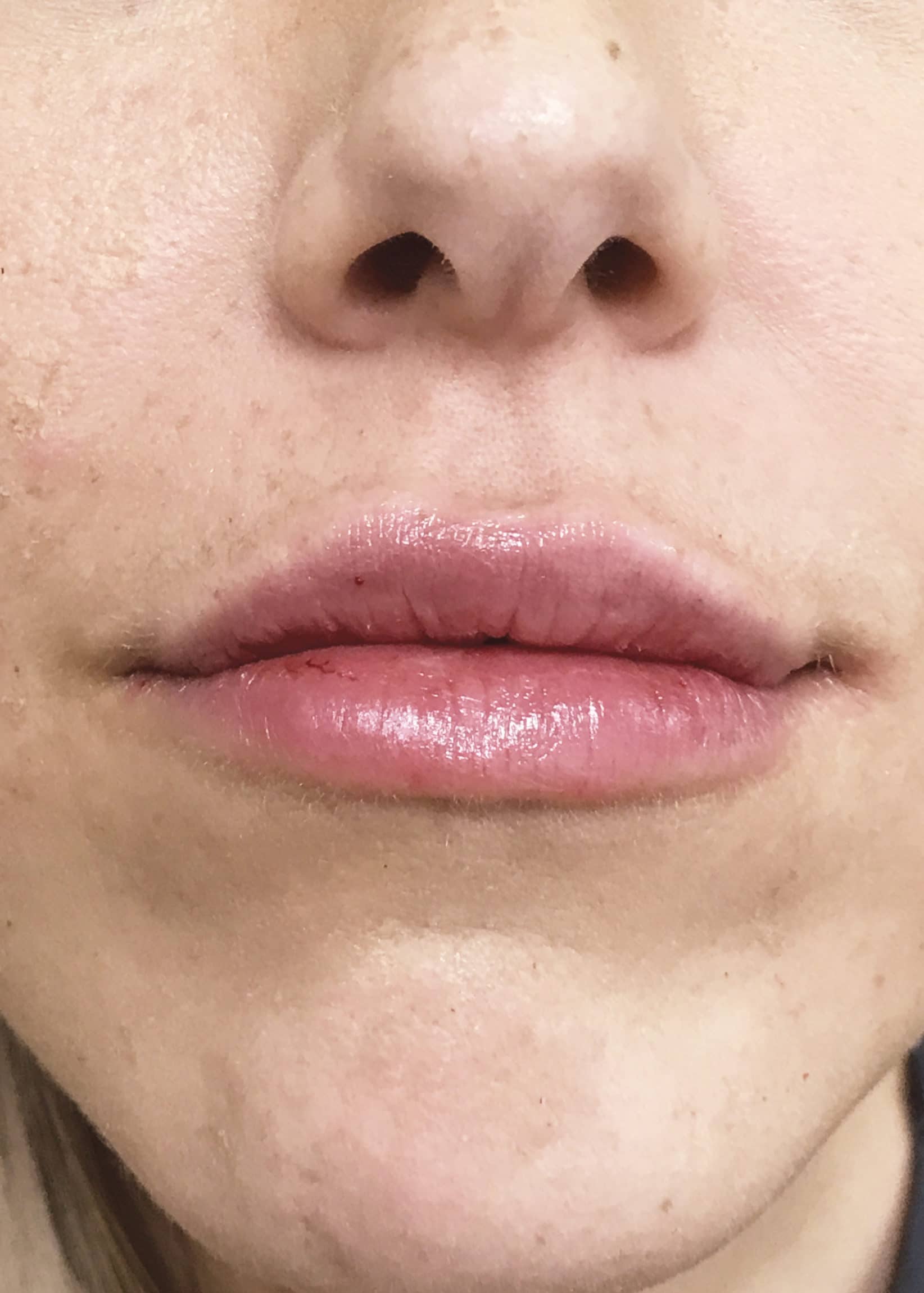 TheSkinCenter ProviderPages AliciaRyan LipFiller After 3 scaled 1