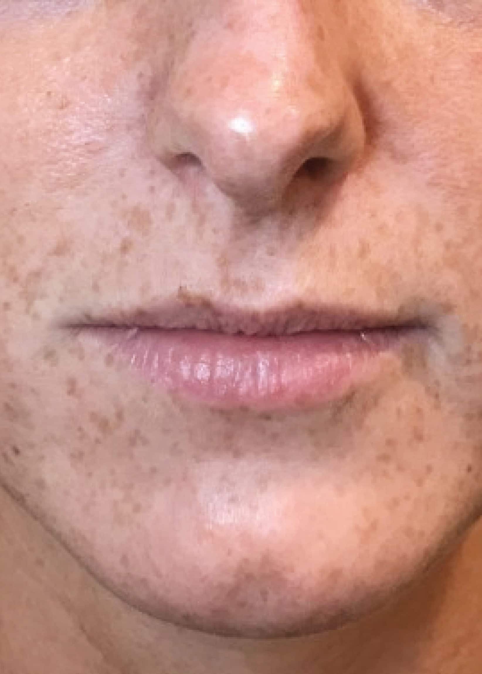 TheSkinCenter ProviderPages AliciaRyan LipFiller Before 1 scaled 1