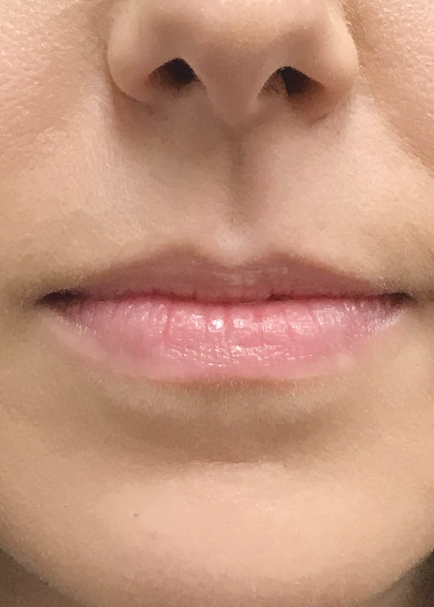 TheSkinCenter ProviderPages AliciaRyan LipFiller Before 4 scaled 1