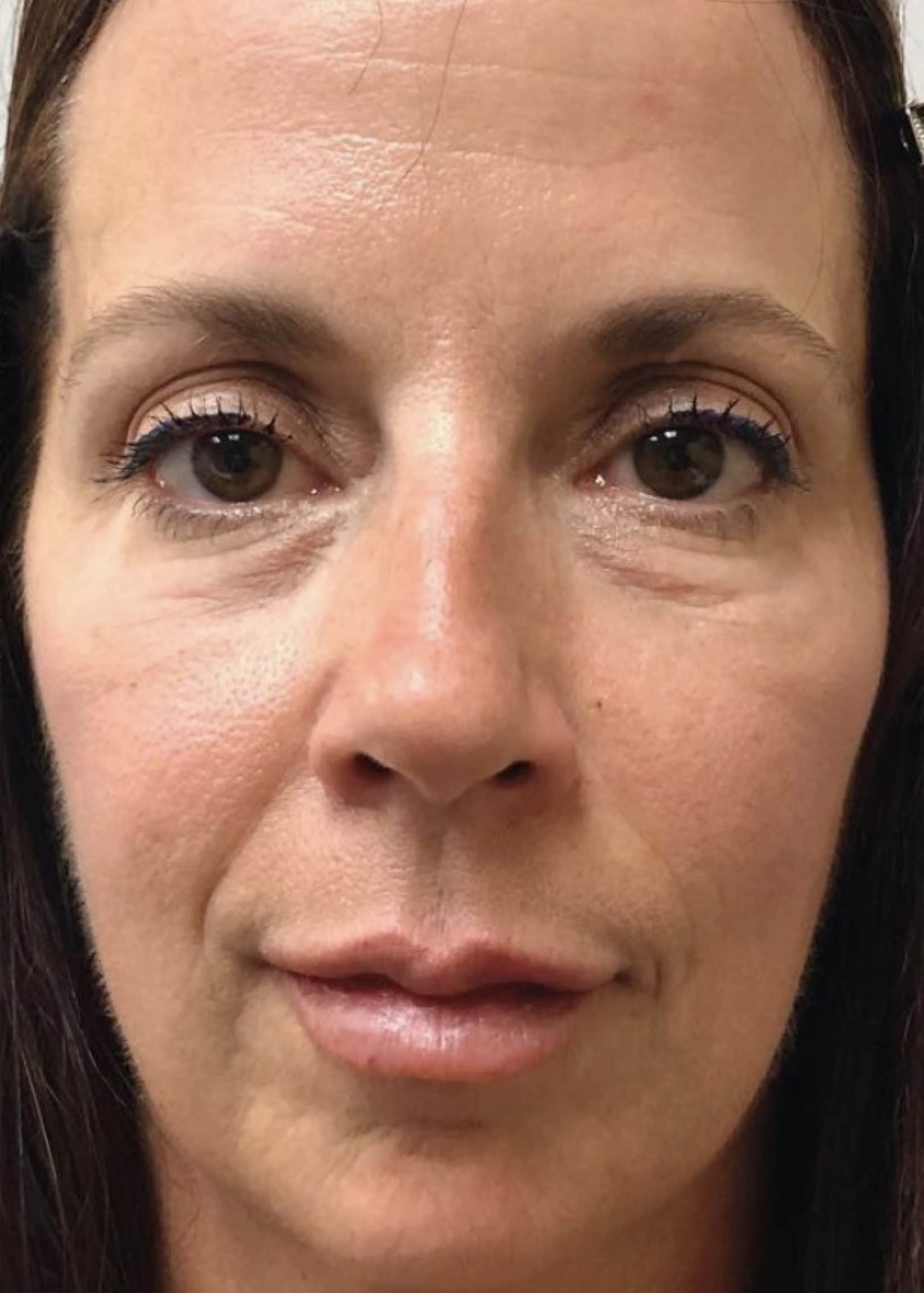 TheSkinCenter ProviderPages AngieKyne FacialFiller After 1 scaled 1