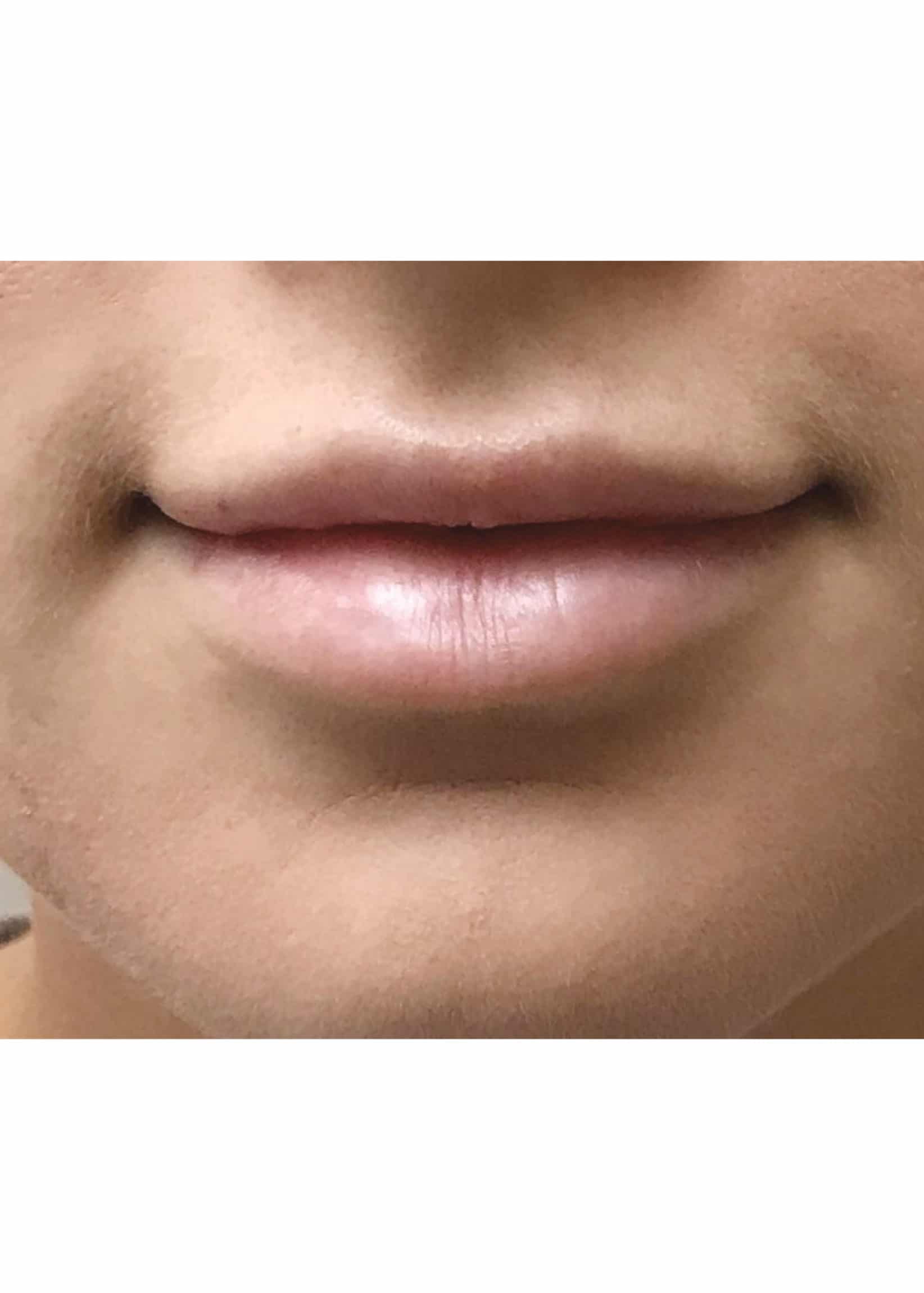 TheSkinCenter ProviderPages AngieKyne LipFiller After 1 scaled 1