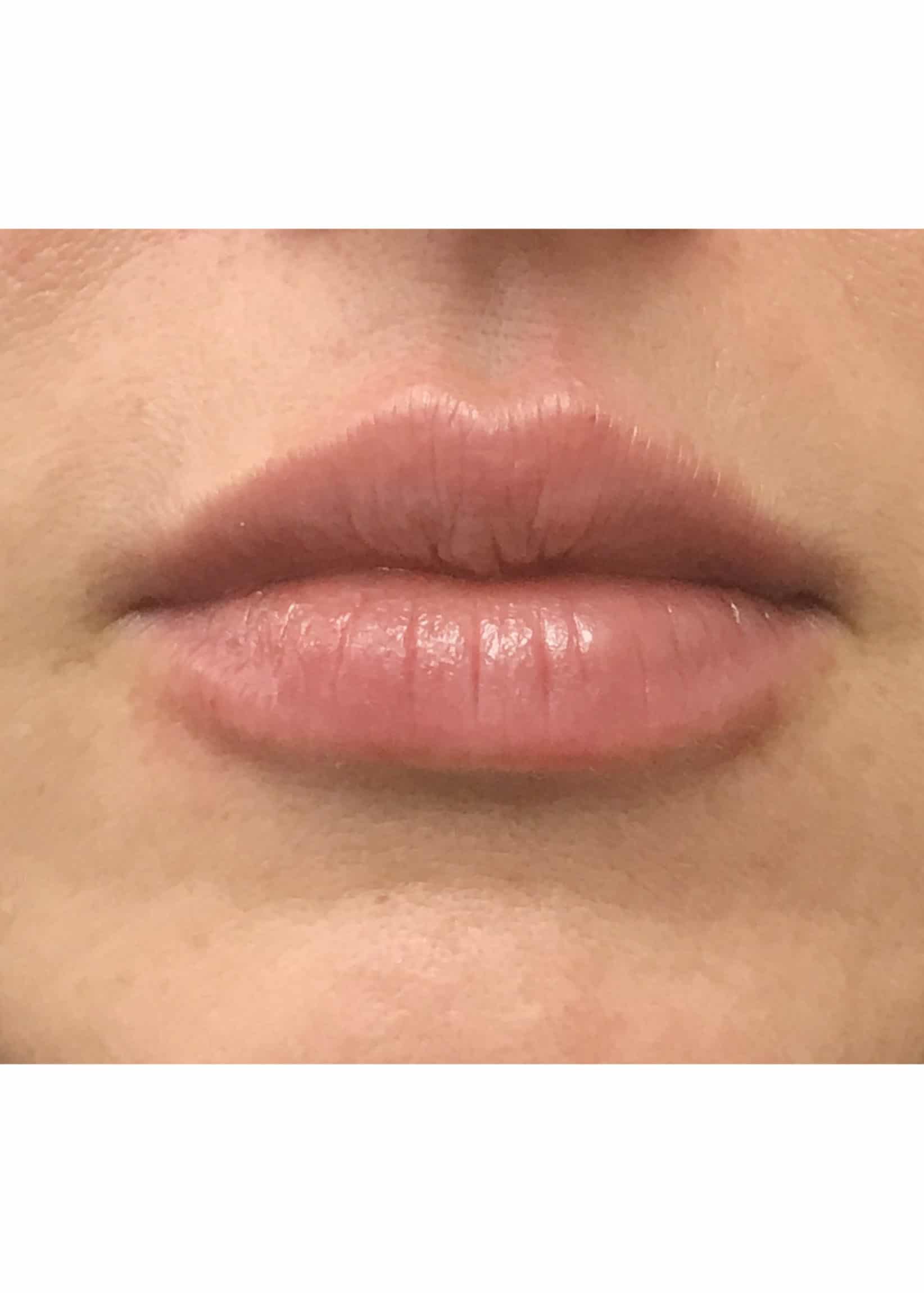 TheSkinCenter ProviderPages AngieKyne LipFiller After 2 scaled 1