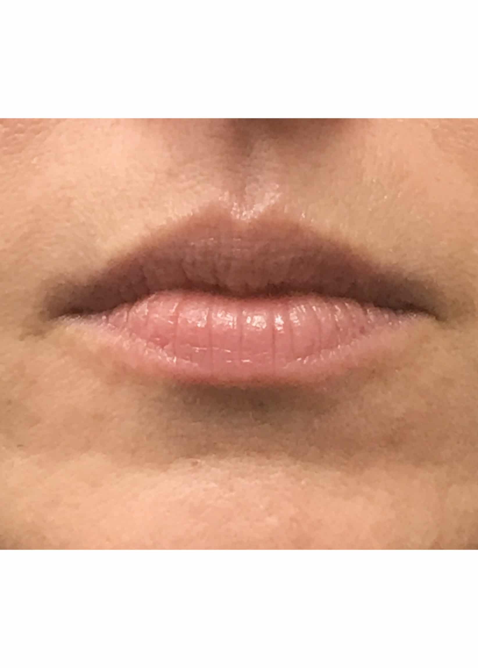 TheSkinCenter ProviderPages AngieKyne LipFiller Before 2 scaled 1
