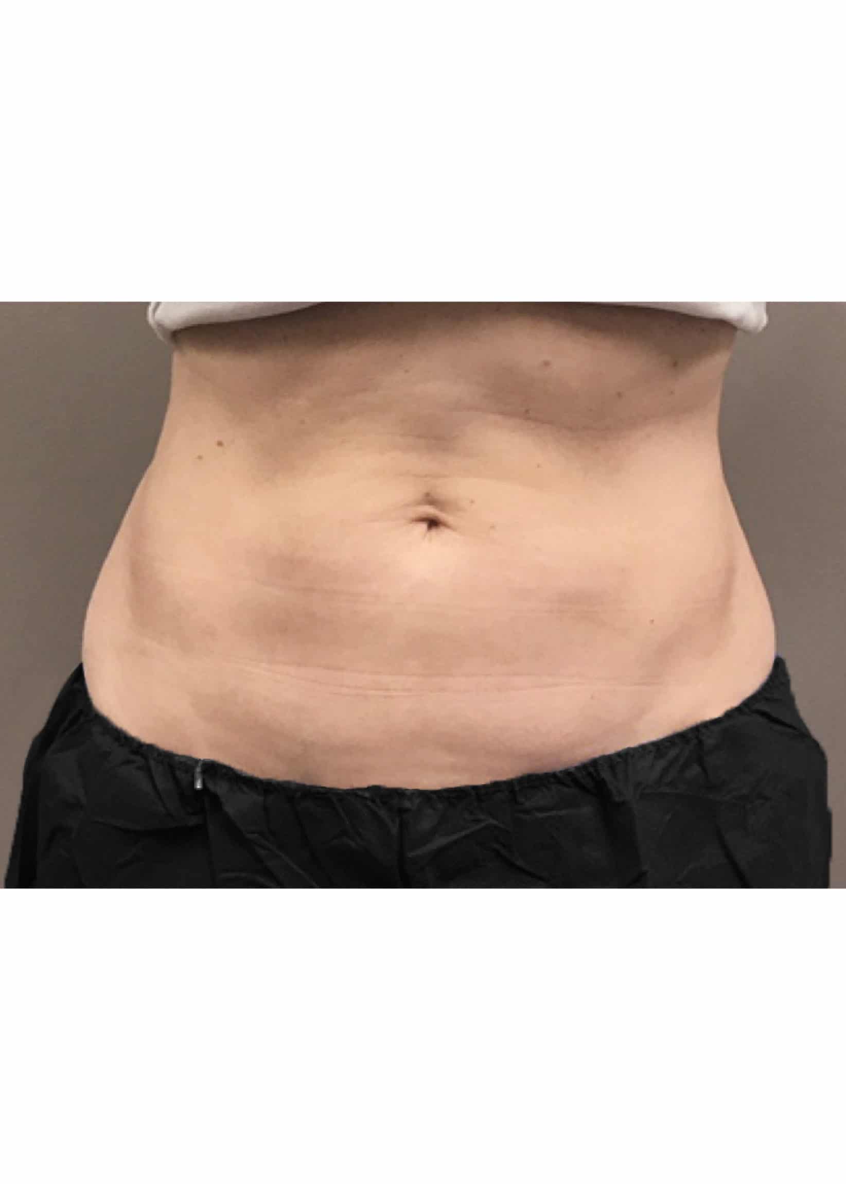 TheSkinCenter ProviderPages BobbiNaples CoolSculpting After 2 scaled 1