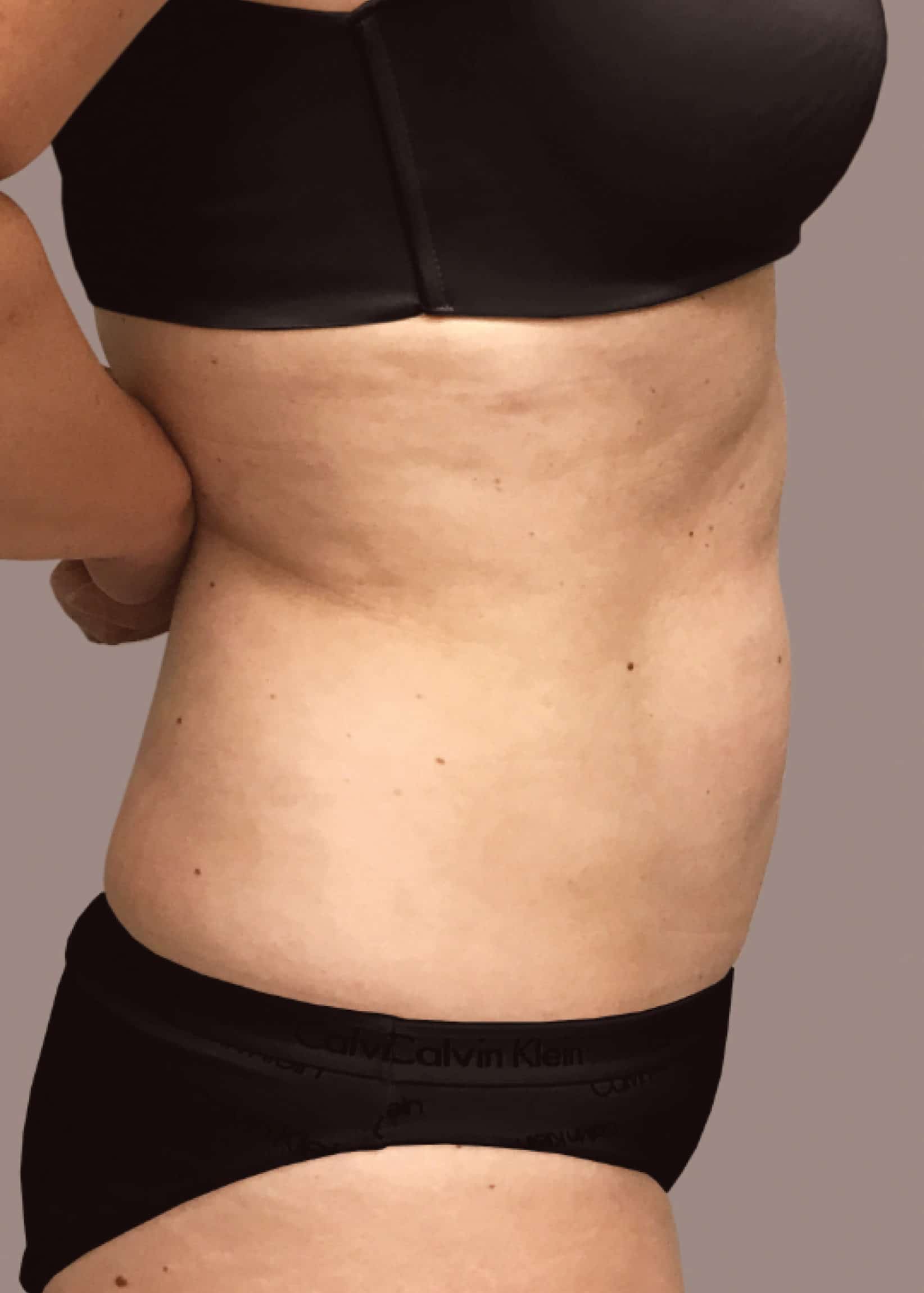 TheSkinCenter ProviderPages BobbiNaples CoolSculpting After 3 scaled 1