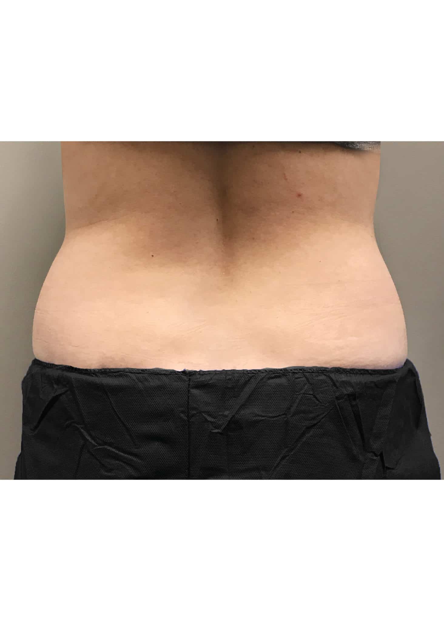 TheSkinCenter ProviderPages BobbiNaples CoolSculpting Before 1 1464x2048 2