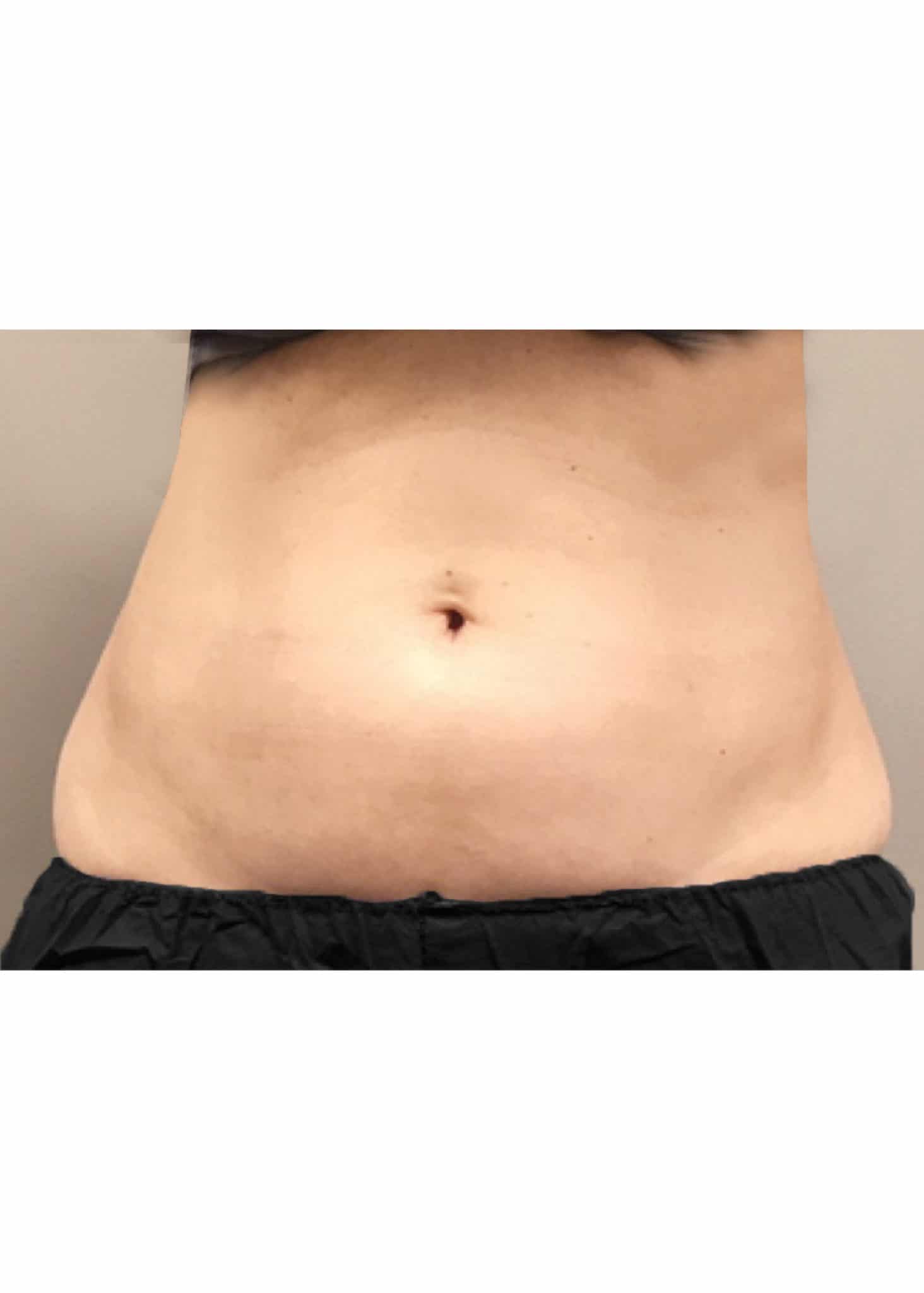 TheSkinCenter ProviderPages BobbiNaples CoolSculpting Before 2 1464x2048 1