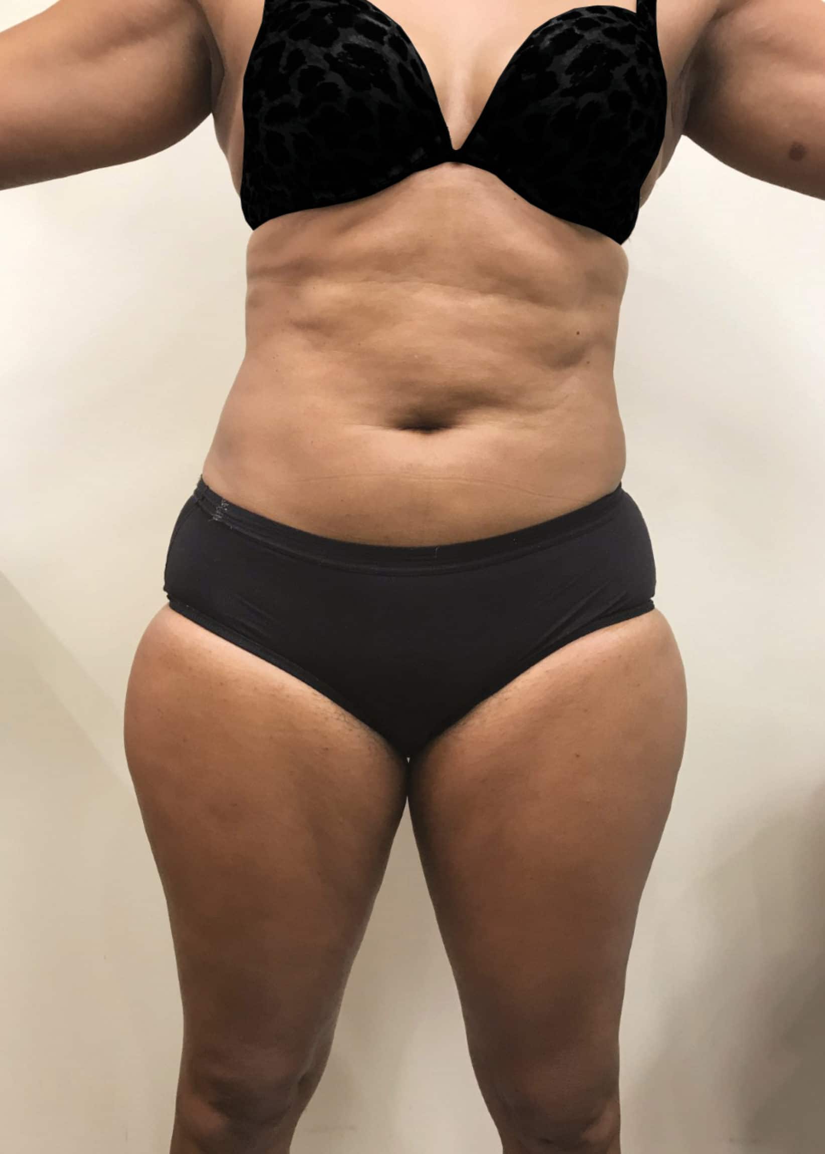 TheSkinCenter ProviderPages BrittanyOliver CoolSculpting After 1 scaled 1