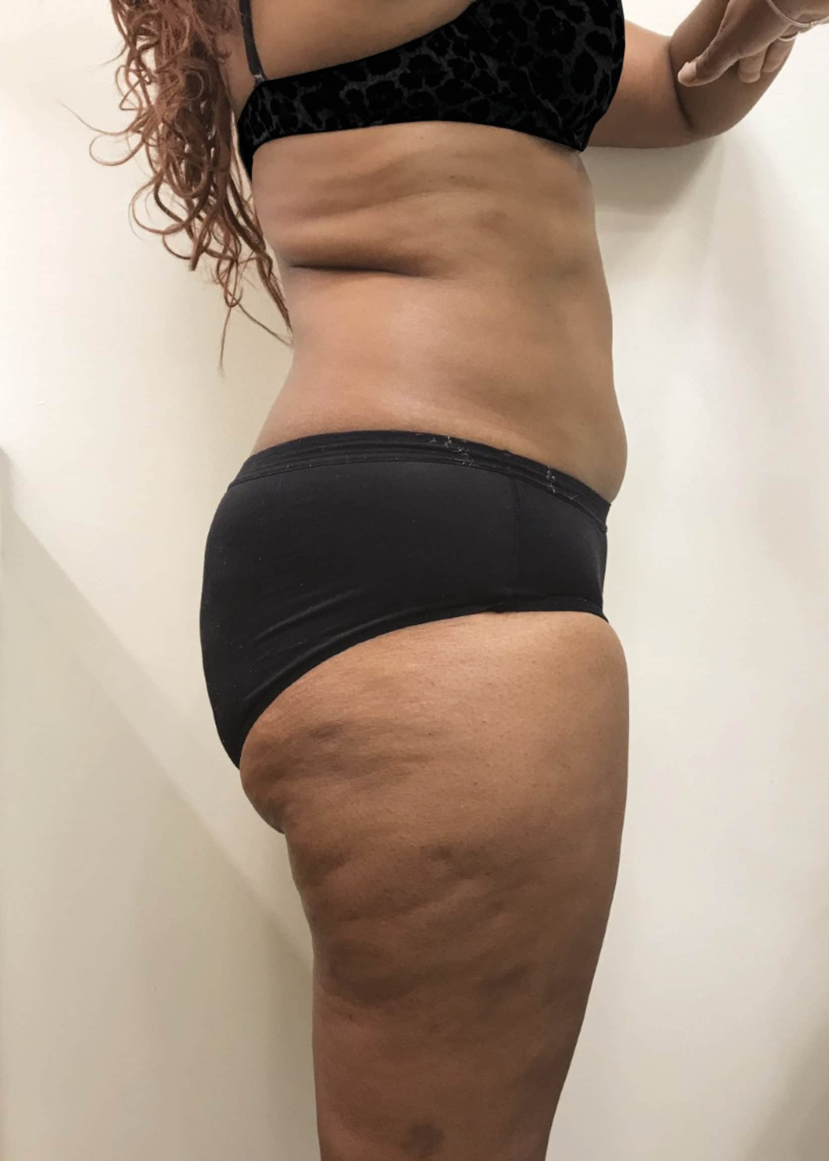 TheSkinCenter ProviderPages BrittanyOliver CoolSculpting After 2 scaled 1
