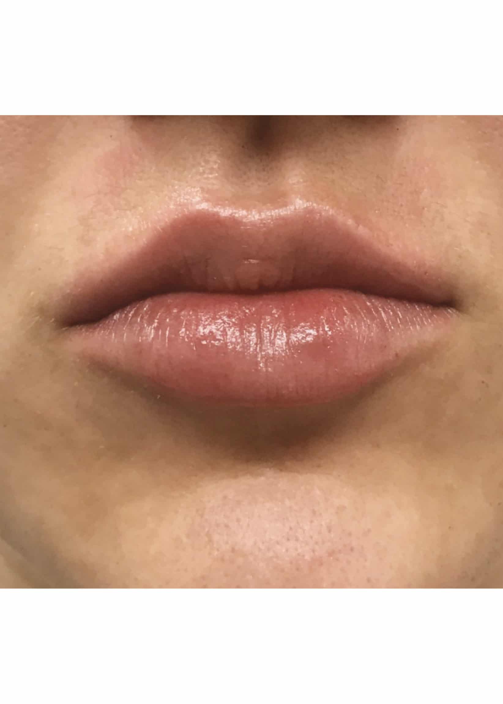 TheSkinCenter ProviderPages JonnaBlum LipFiller After 1 scaled 1