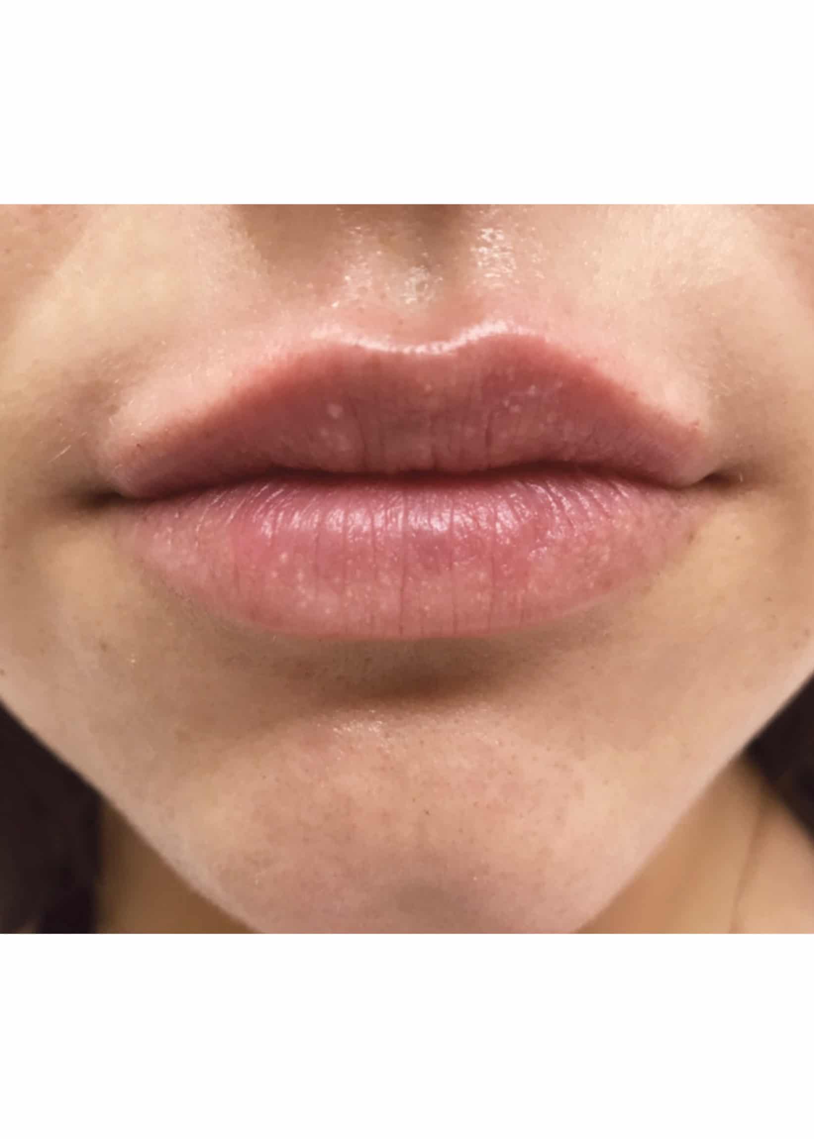 TheSkinCenter ProviderPages JonnaBlum LipFiller After 3 scaled 1