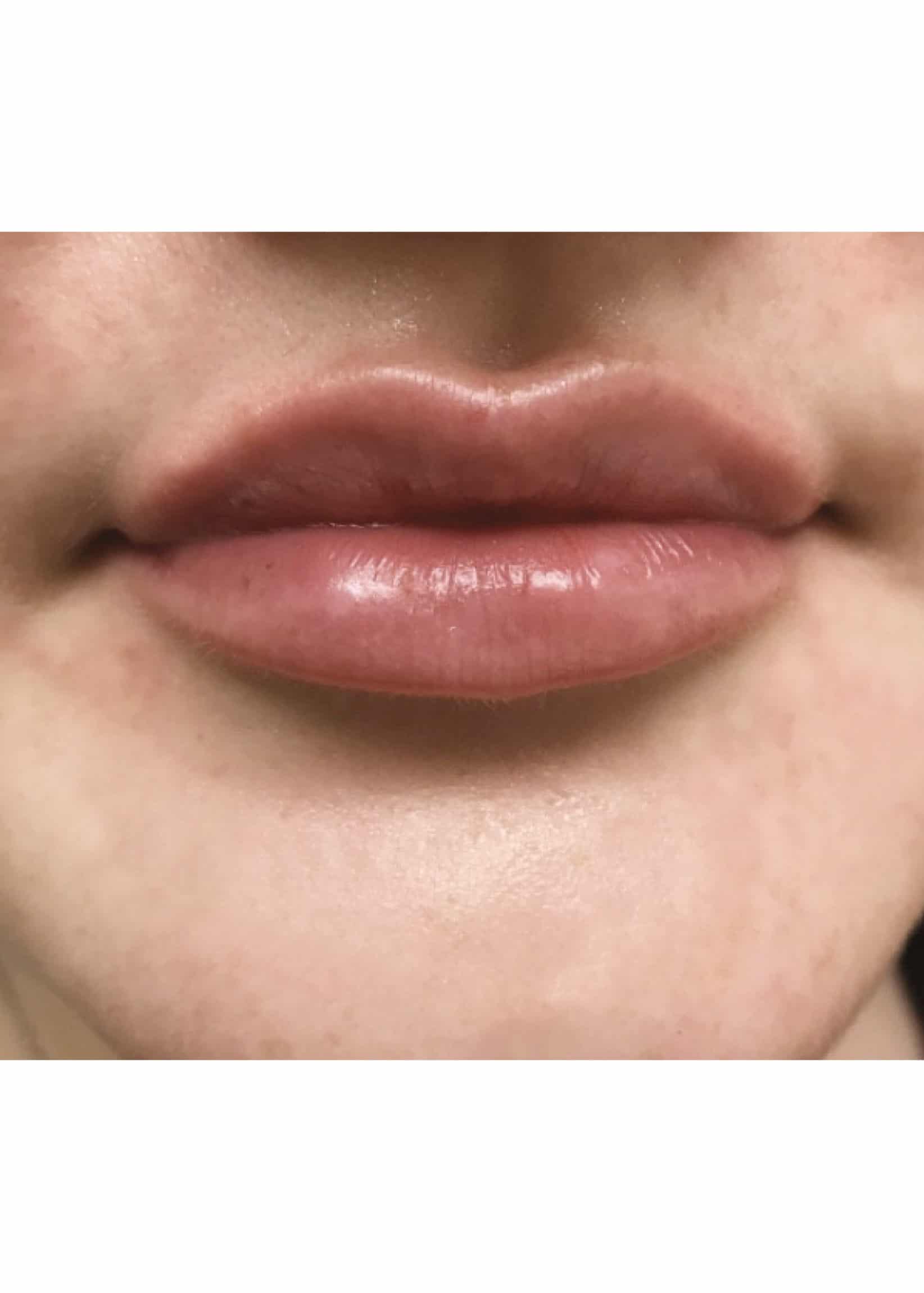 TheSkinCenter ProviderPages JonnaBlum LipFiller After 4 scaled 1