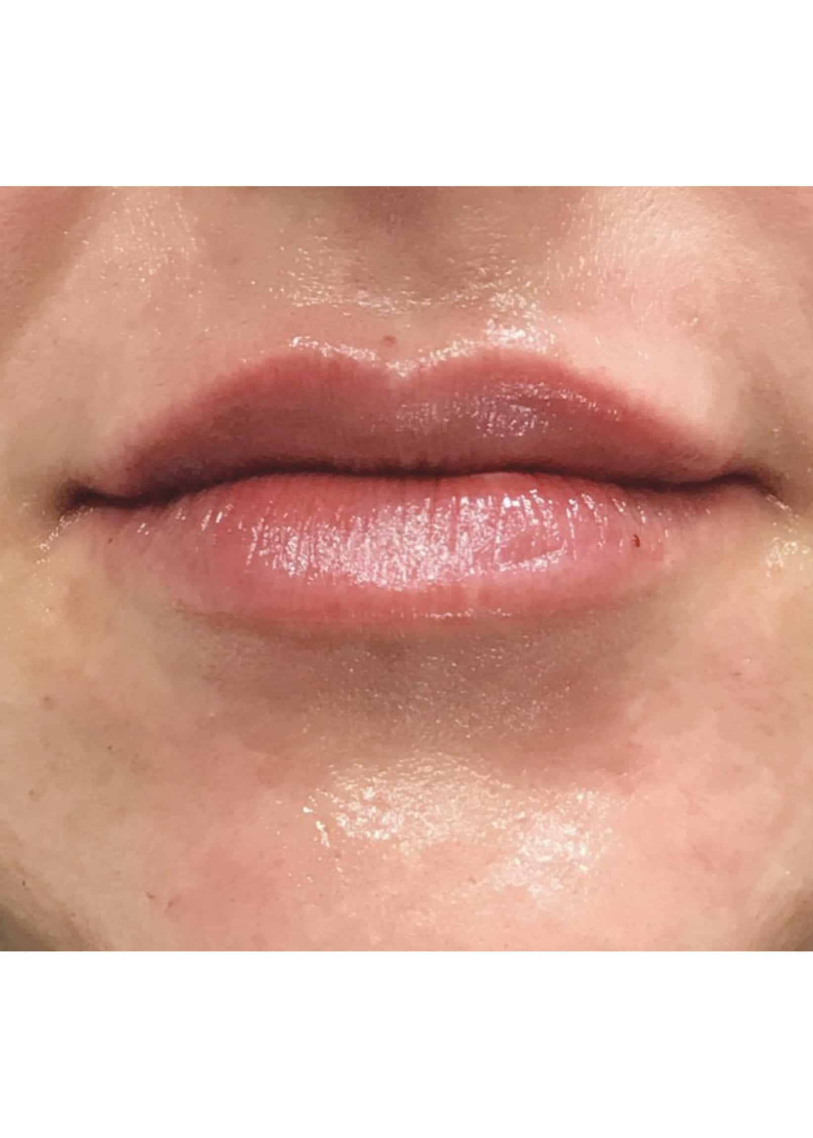 TheSkinCenter ProviderPages JonnaBlum LipFiller After 5 scaled 1