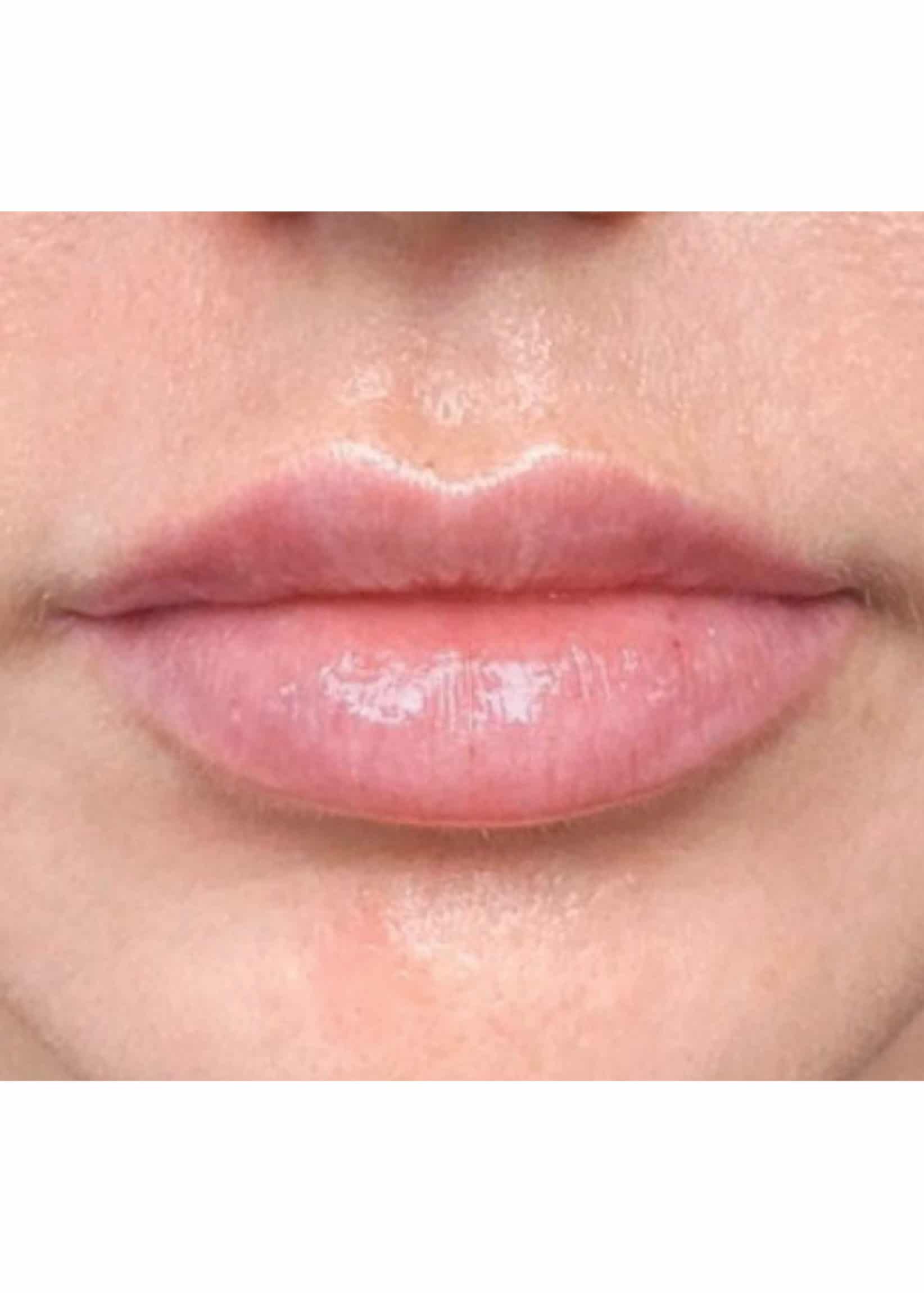 TheSkinCenter ProviderPages JonnaBlum LipFiller After 6 scaled 1