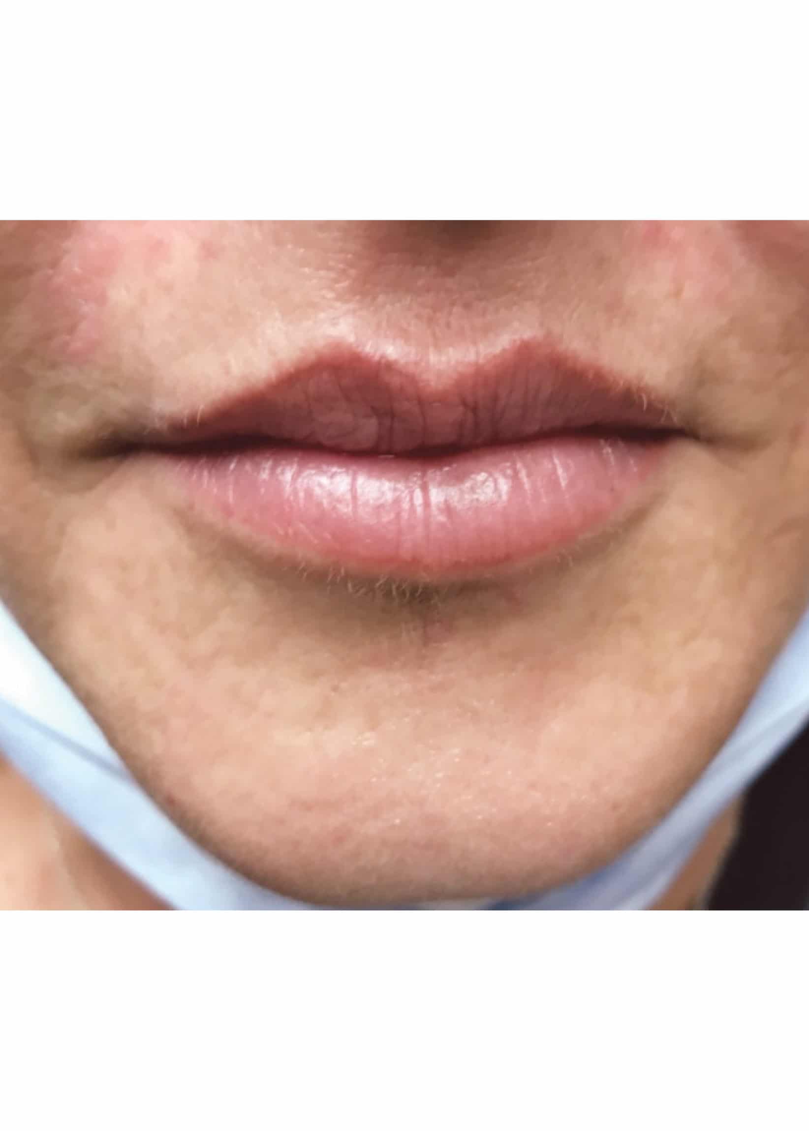 TheSkinCenter ProviderPages JonnaBlum LipFiller Before 2 scaled 1