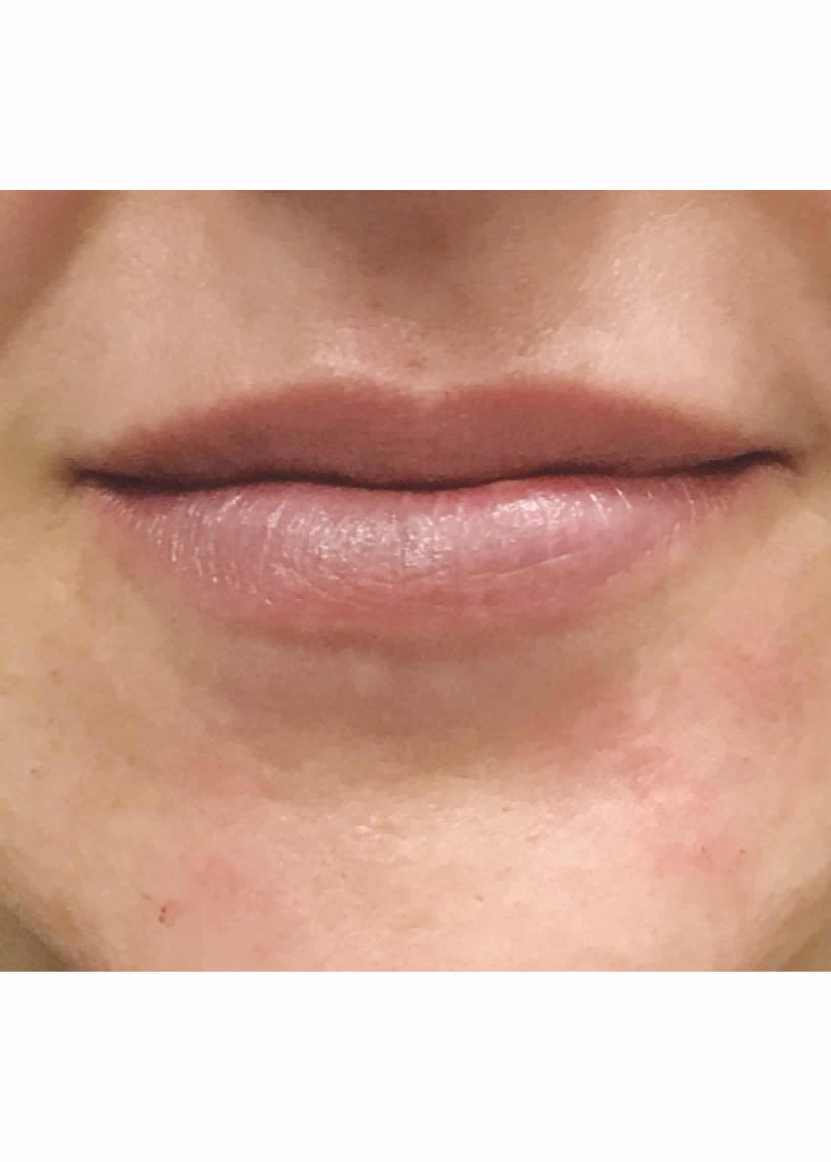 TheSkinCenter ProviderPages JonnaBlum LipFiller Before 5 scaled 1