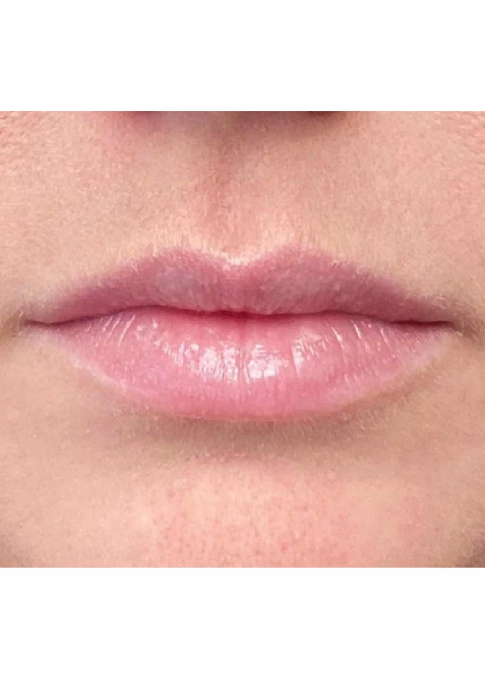 TheSkinCenter ProviderPages JonnaBlum LipFiller Before 6 scaled 1
