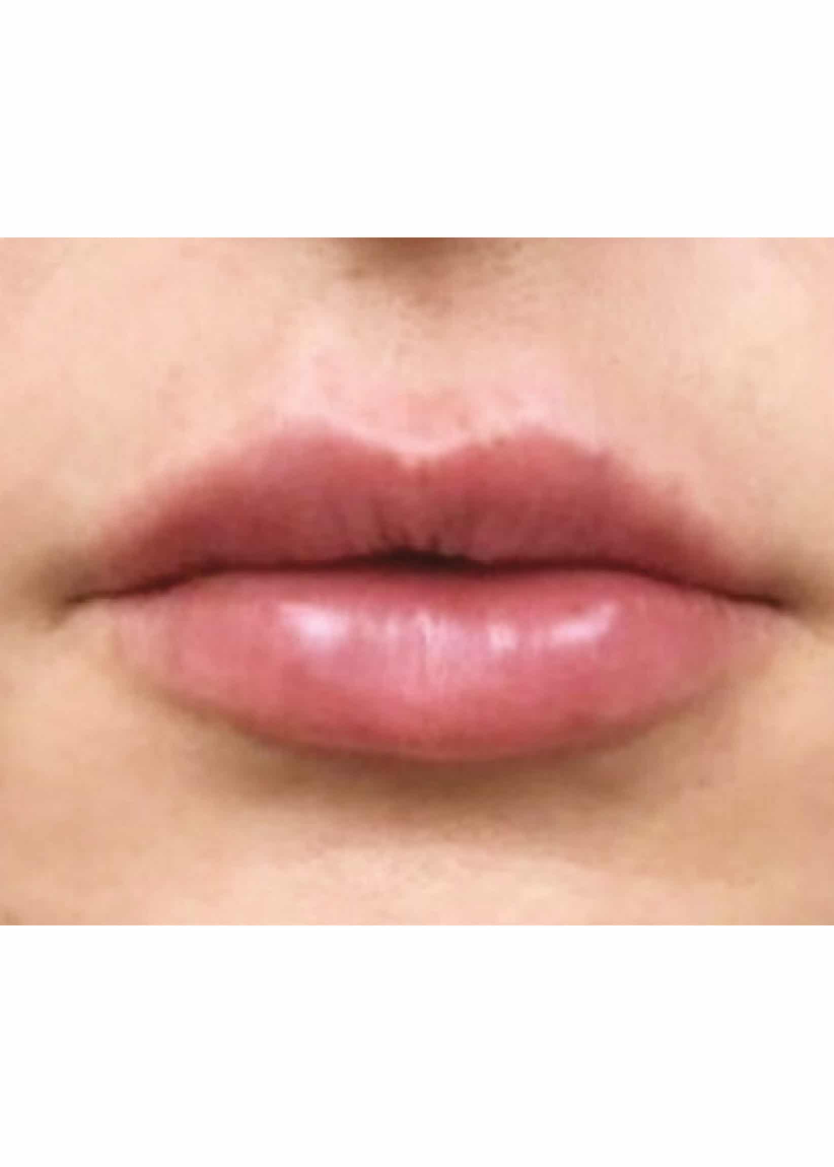 TheSkinCenter ProviderPages TiffaneyBeddow LipFiller After 2 scaled 1