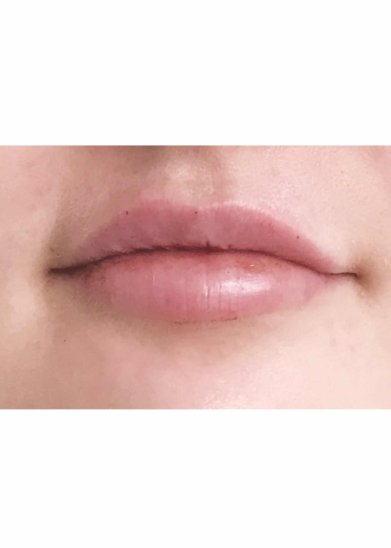 TheSkinCenter ProviderPages TiffaneyBeddow LipFiller After 4 scaled 1