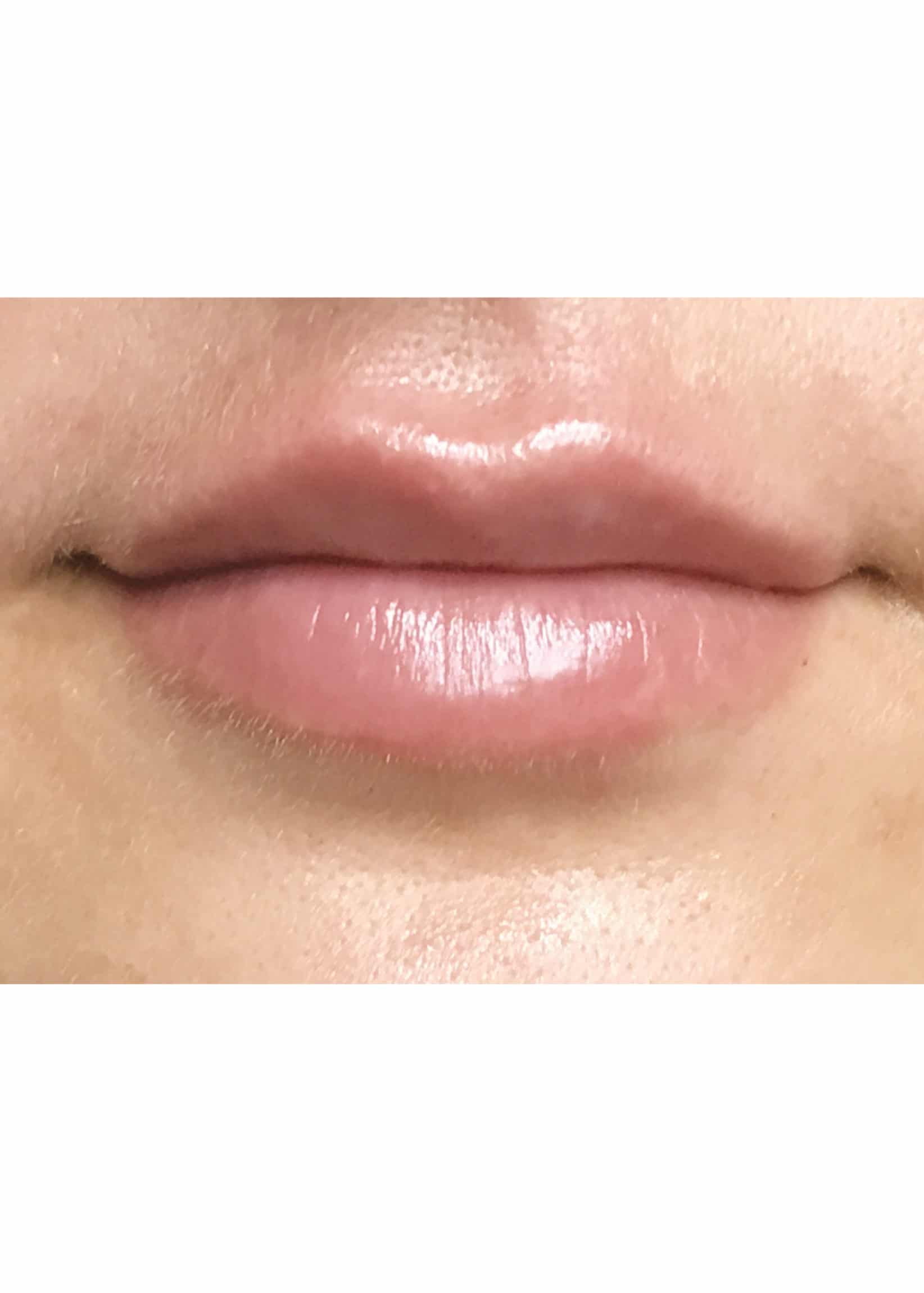TheSkinCenter ProviderPages TiffaneyBeddow LipFiller After 5 scaled 1