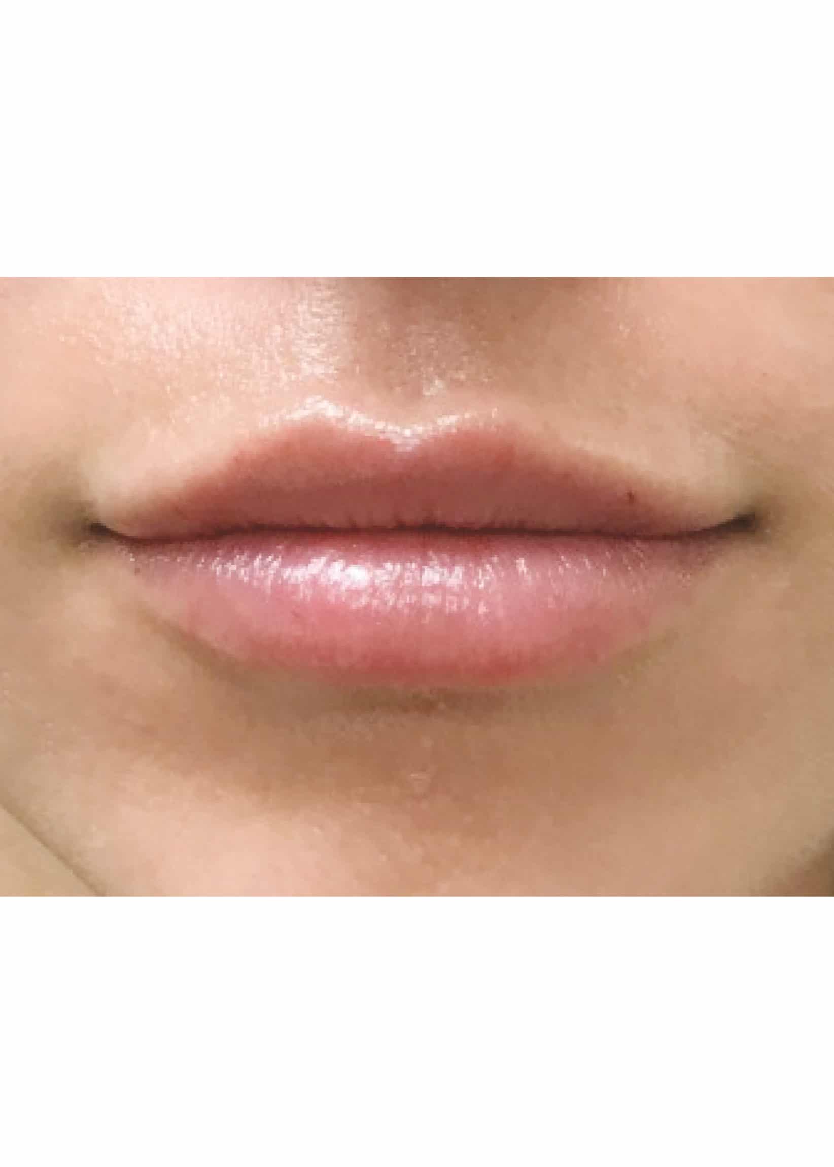 TheSkinCenter ProviderPages TiffaneyBeddow LipFiller After 6 scaled 1