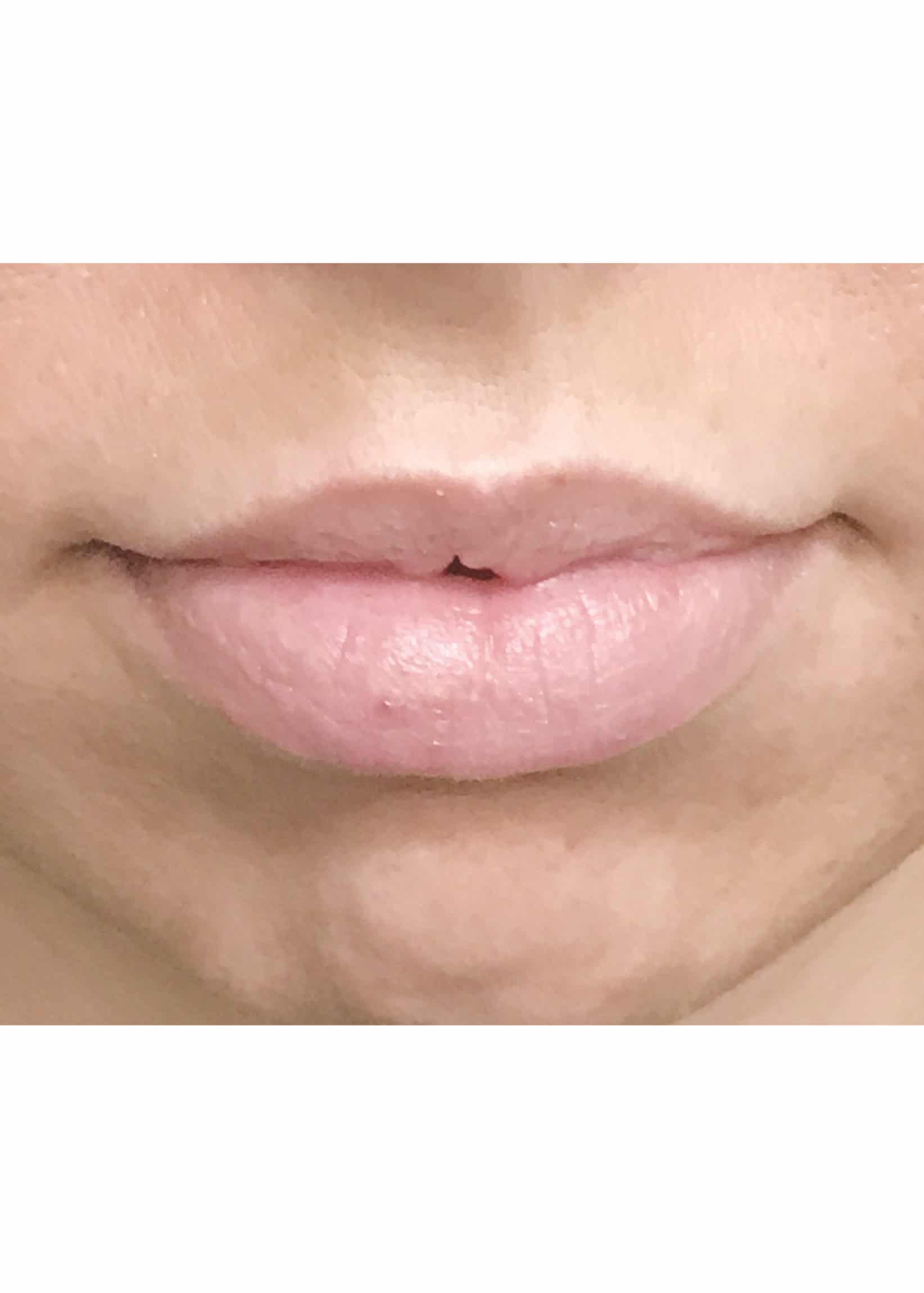 TheSkinCenter ProviderPages TiffaneyBeddow LipFiller Before 1 scaled 1