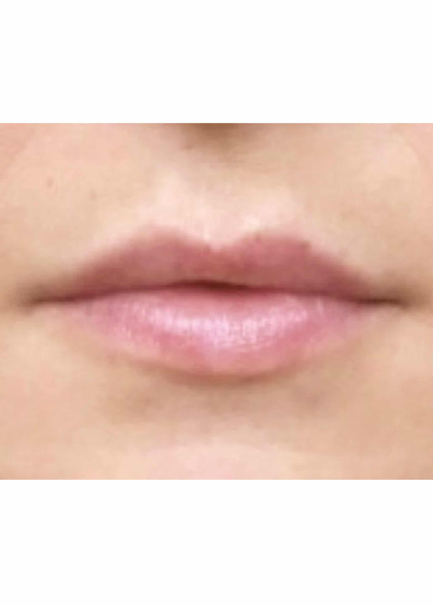 TheSkinCenter ProviderPages TiffaneyBeddow LipFiller Before 2 scaled 1