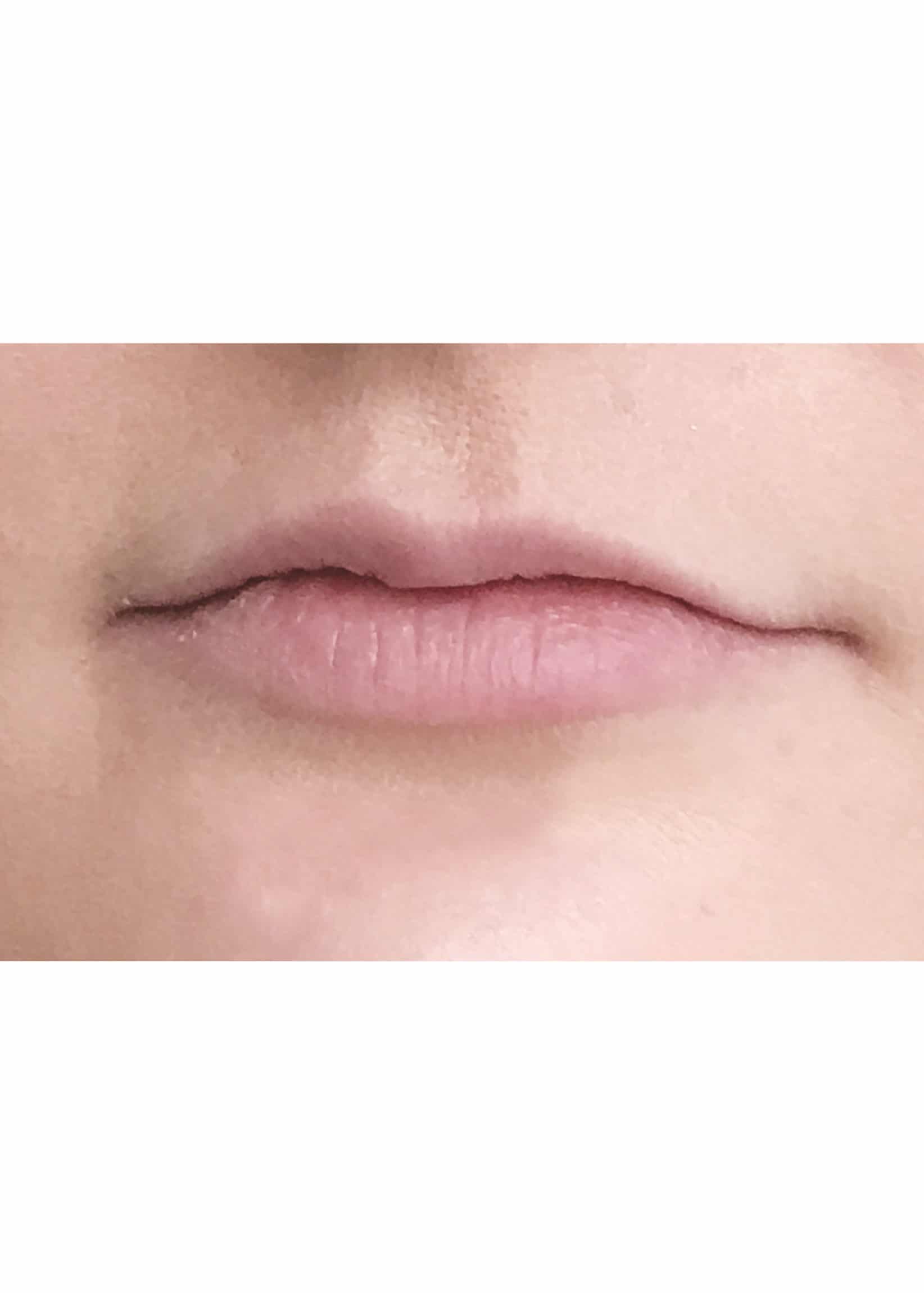 TheSkinCenter ProviderPages TiffaneyBeddow LipFiller Before 4 scaled 1