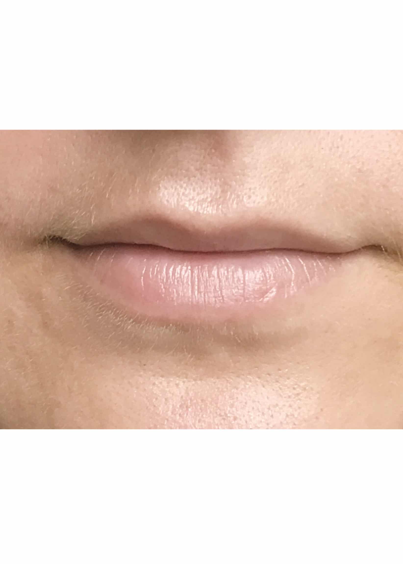 TheSkinCenter ProviderPages TiffaneyBeddow LipFiller Before 5 scaled 1