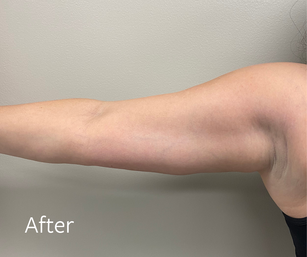 TheSkinCenter Website CoolSculpting Arms After