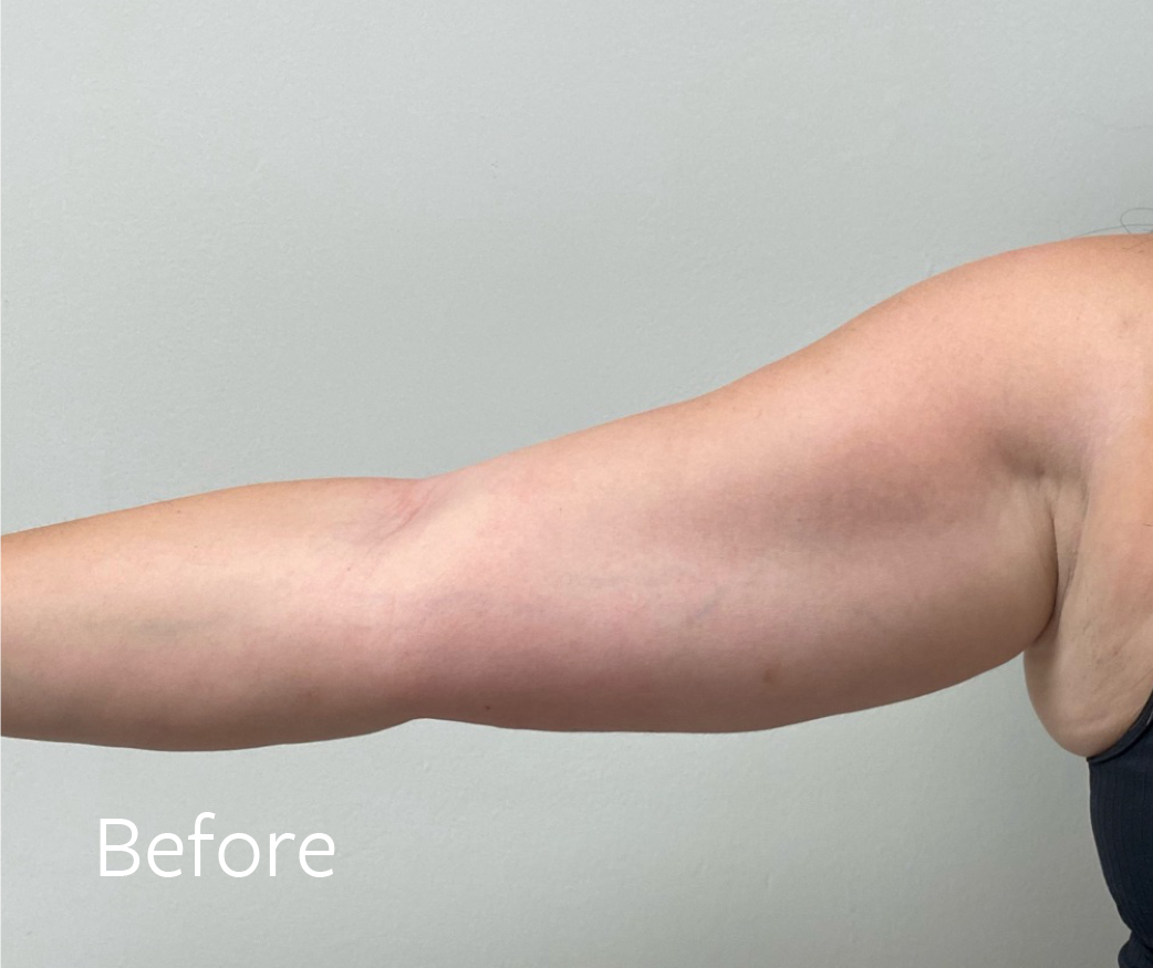 TheSkinCenter Website CoolSculpting Arms Before