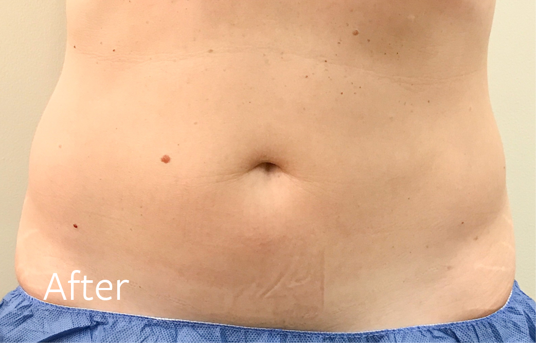 TheSkinCenter Website Coolsculpting Abdomen Front After