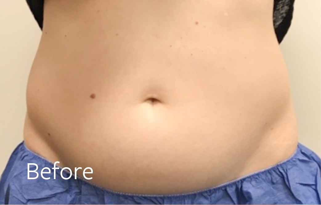 TheSkinCenter Website Coolsculpting Abdomen Front Before