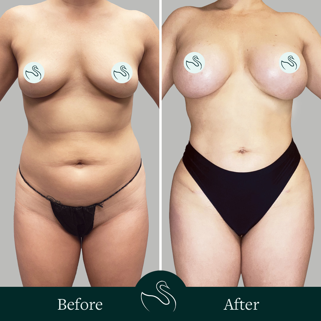 SUR 032723 BeforeAfter LIPO AB BAM BBL SOCAD Brown