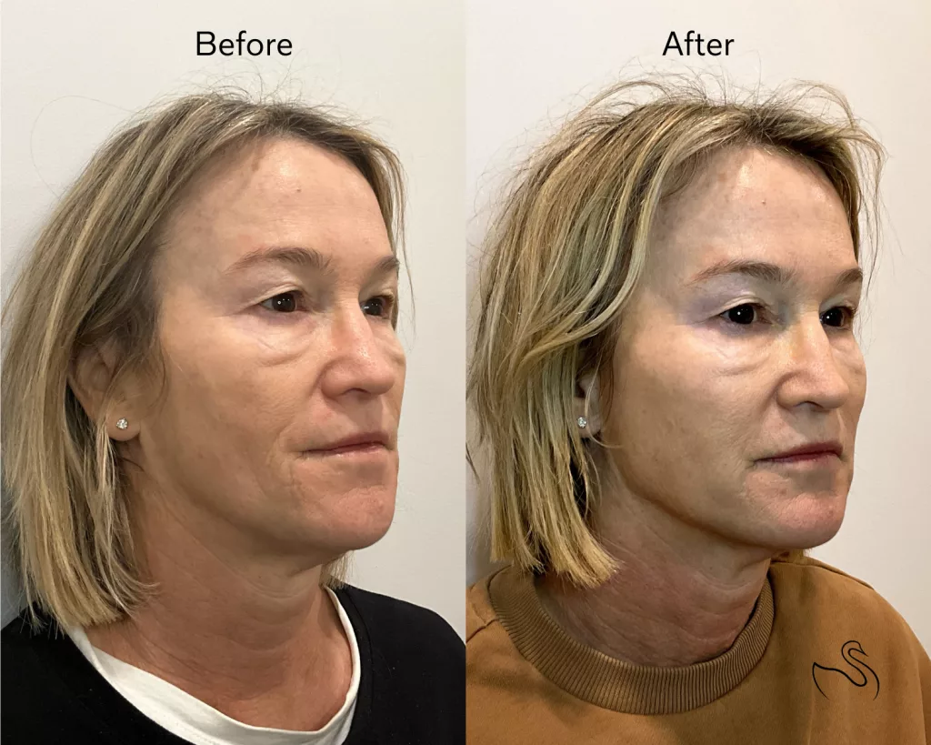 Before and after dermal filler treatment performed at The Skin Center in Cleveland, OH. Dermal filler placement to the cheeks for added volume and the jawline for enhanced definition. 