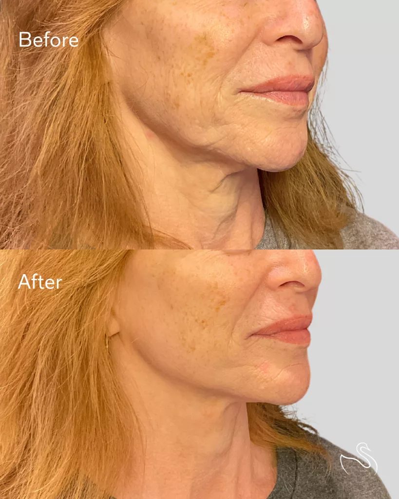 Before and After Radiesse treatment performed at The Skin Center, Pittsburgh, PA