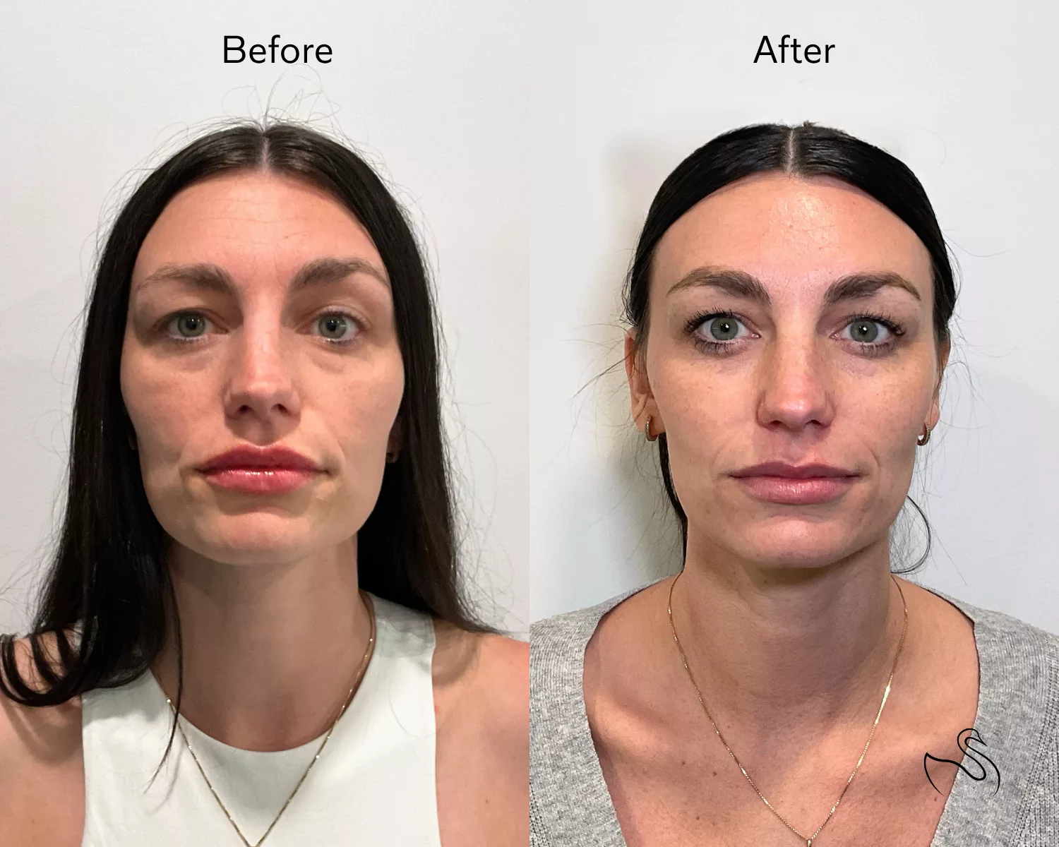 Before and after Radiesse collagen stimulating treatment preformed at The Skin Center in Pittsburgh, PA.