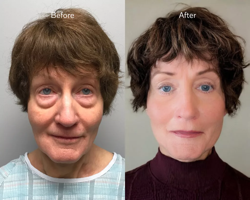 Before and After Quicklift facelift and blepharoplasty performed on 77 year-old female at The Skin Center. 