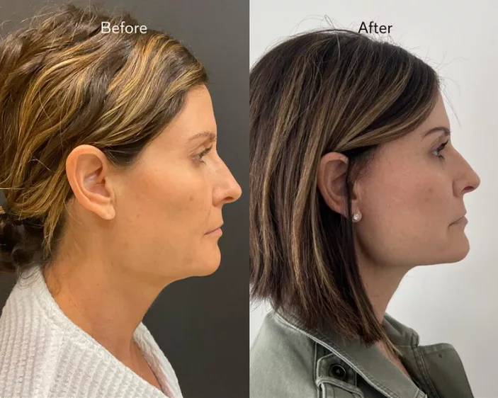 QuickLift facelift performed by Dr. Colon at The Skin Center in Columbus, OH. Before and after QuickLift facelift.  