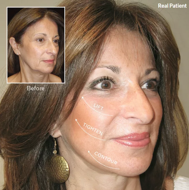 Before and After facelift results. Quicklift facelift performed in Pittsburgh at The Skin Center.