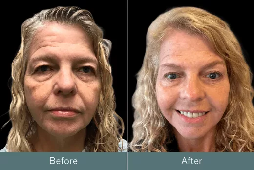 Before and after Quicklift facelift with upper and lower blepharoplasty. Performed on a 60-year-old female.
