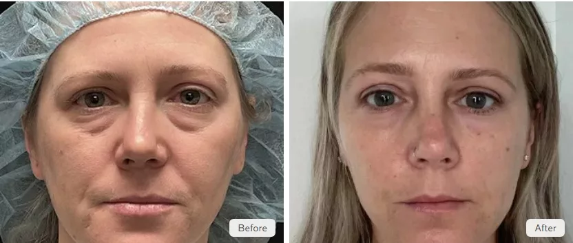 Blepharoplasty surgery performed by Dr. Jason Tomsic at The Skin Center in Pittsburgh. Before and After blepharoplasty surgery photos of a female patient.