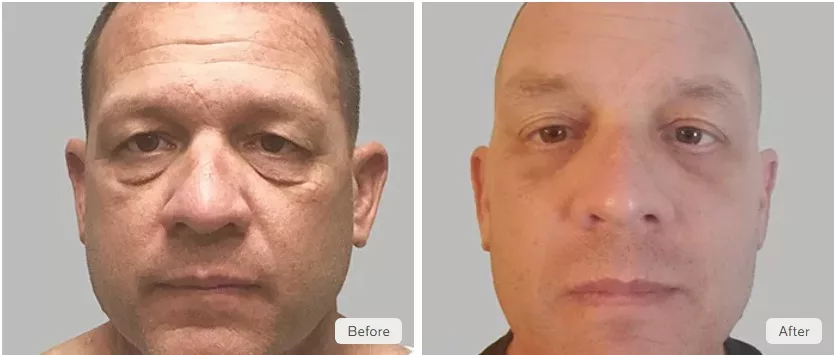 Before and after photos of upper and lower blepharoplasty surgery performed at The Skin Center in Pittsburgh. 