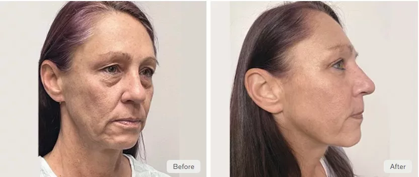 EyeQ Eye Lift, or lower blepharoplasty, performed at The Skin Center in Pittsburgh, PA.