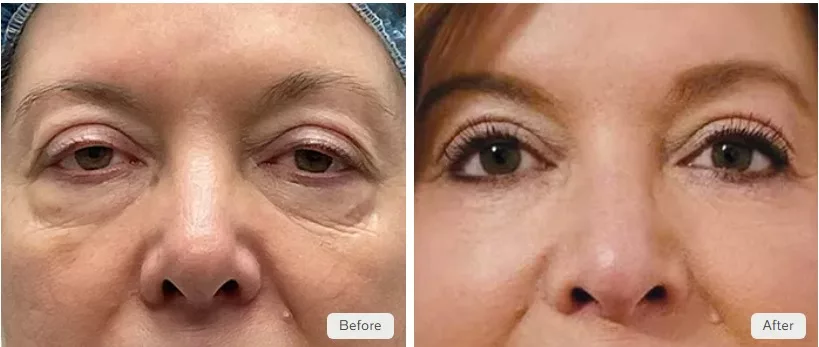 Before and after the EyeQ Eye Lift, blepharoplasty, to eliminate under-eye bags and rejuvenate the eyes. Performed at The Skin Center in Pittsburgh, PA by Dr. Jason Tomsic.